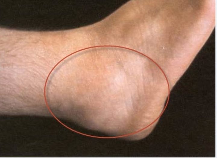 Аминисики порвал ахиллесово сухожилие