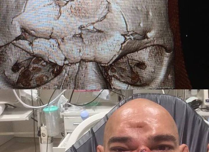 У ЕВАНГЕЛИСТЫ САНТОСА ЧЕРЕПНО-МОЗГОВАЯ ТРАВМА