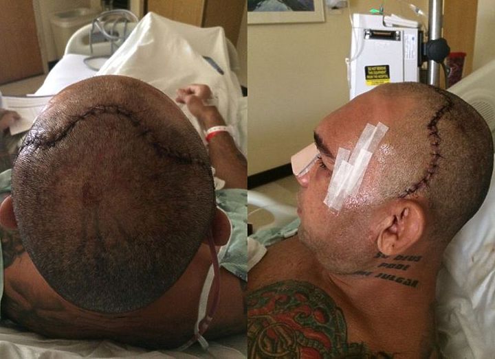 Киборг Сантос успешно прооперирован