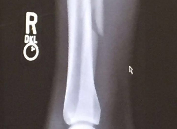 Питбуль сломал малоберцовую кость голени