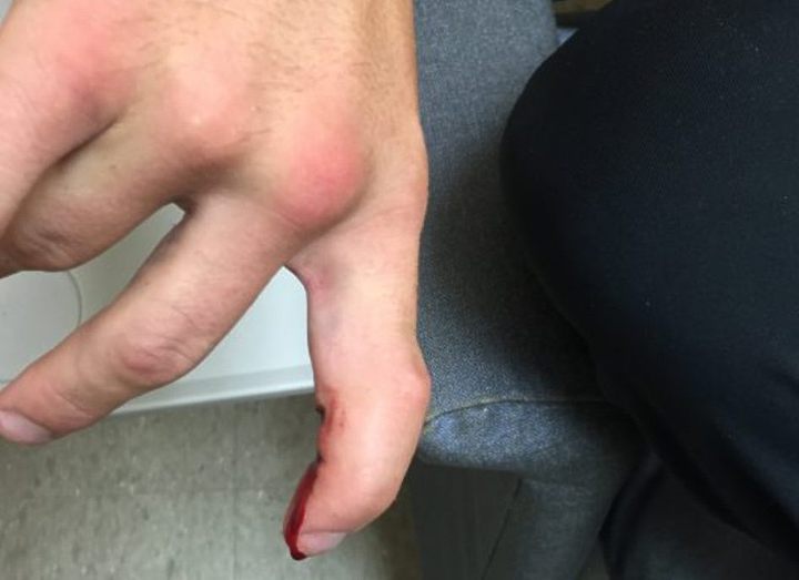 ТРАВМА БРАУНА, ПОЛУЧЕННАЯ В БОЮ С ВЕРДУМОМ