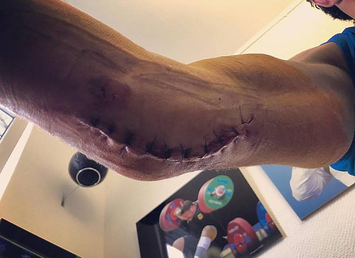 Мигран Арутюнян показал прооперированную руку