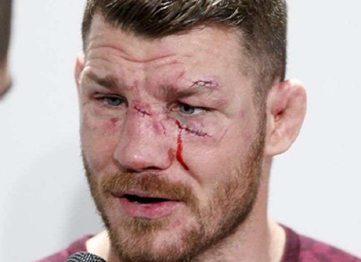 Майклу Биспингу предстоит операция