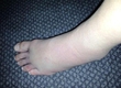 ROSS PEARSON'S FOOT AFTER FIGHT WITH RYAN KUTYUR