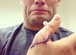 JOSH THOMSON'S HAND AFTER OPERATION